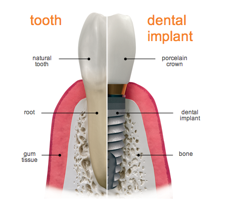 Dental Implant Crown Restoration