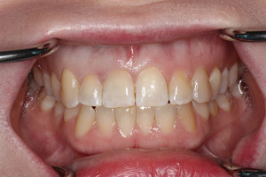 After Minimally Invasive Dental Treatment