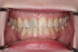Internal Staining - prior to minimally invasive dental treatment