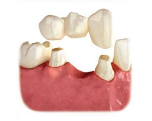 A dental bridge for replacing missing teeth. The Knoxville Dentist for family dentistry, cosmetic dentistry, invisalign, implants, bridges, crowns and veneers. Tooth replacement options