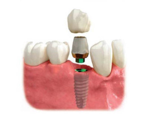 Implant and crown for replacing missing teeth