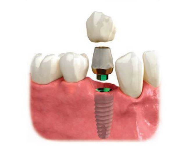 implant; crown; tooth replacement
