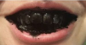 Another method of teeth whitening