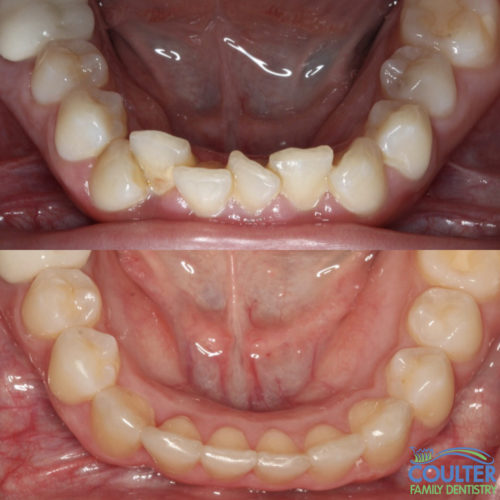Photograph of invisalign results after straightening lower teeth