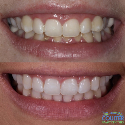 Photograph of invisalign results straightening teeth
