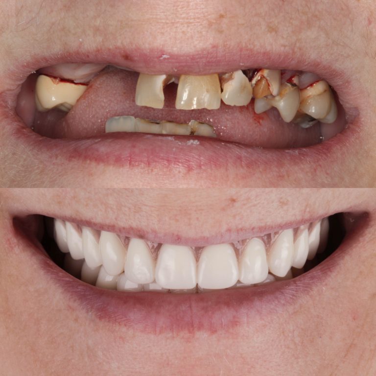 Dentures to replace missing teeth Knoxville Family Dentistry