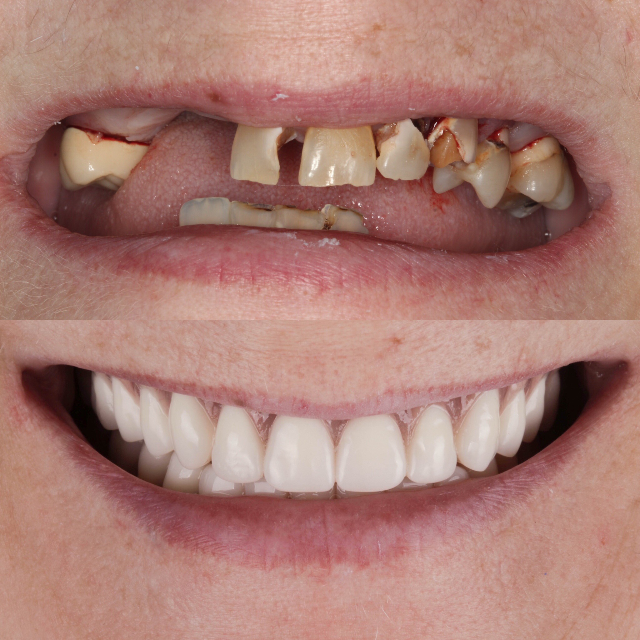 Dentures replacing missing teeth