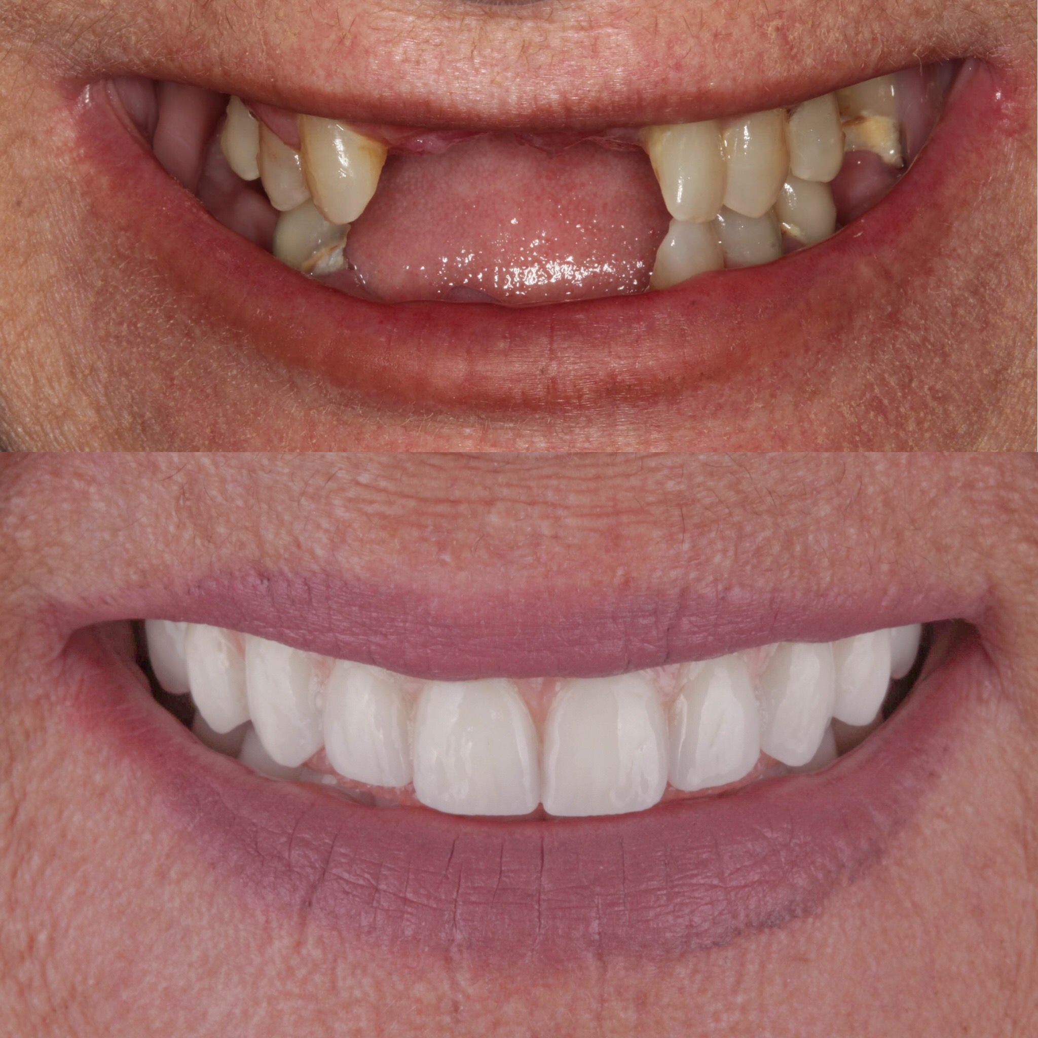 dental implants supporting a zirconia hybrid denture