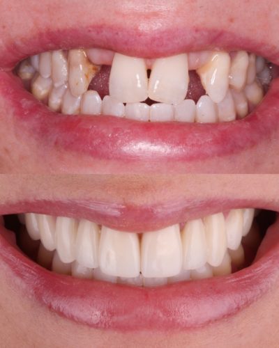 A before and after of cosmetic dentistry with crowns and veneers