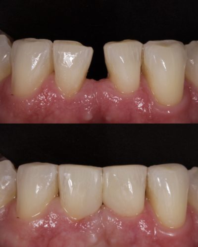 Cosmetic bonding to improve the shape of teeth